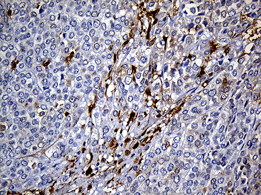 M-PST / STM Antibody - Immunohistochemical staining of paraffin-embedded Adenocarcinoma of Human breast tissue tissue using anti-SULT1A3 mouse monoclonal antibody. (Heat-induced epitope retrieval by 1mM EDTA in 10mM Tris buffer. (pH8.5) at 120°C for 3 min. (1:500)