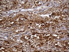M-PST / STM Antibody - Immunohistochemical staining of paraffin-embedded Carcinoma of Human lung tissue using anti-SULT1A3 mouse monoclonal antibody. (Heat-induced epitope retrieval by 1mM EDTA in 10mM Tris buffer. (pH8.5) at 120°C for 3 min. (1:500)