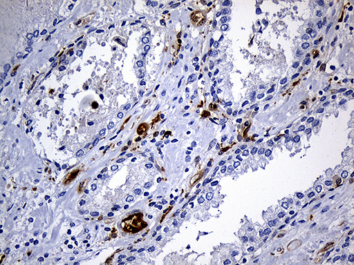 M-PST / STM Antibody - Immunohistochemical staining of paraffin-embedded Carcinoma of Human prostate tissue using anti-SULT1A3 mouse monoclonal antibody. (Heat-induced epitope retrieval by 1mM EDTA in 10mM Tris buffer. (pH8.5) at 120°C for 3 min. (1:500)