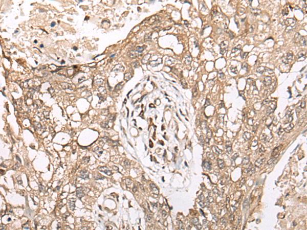 M1AP Antibody - Immunohistochemistry of paraffin-embedded Human lung cancer tissue  using M1AP Polyclonal Antibody at dilution of 1:45(×200)
