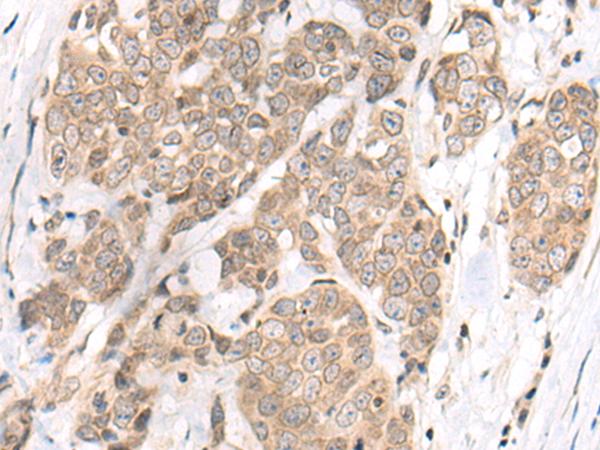 M1AP Antibody - Immunohistochemistry of paraffin-embedded Human thyroid cancer tissue  using M1AP Polyclonal Antibody at dilution of 1:80(×200)