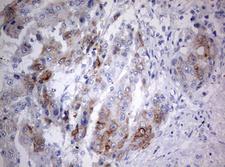 MAATS1 Antibody - IHC of paraffin-embedded Carcinoma of Human liver tissue using anti-C3orf15 mouse monoclonal antibody. (Heat-induced epitope retrieval by 10mM citric buffer, pH6.0, 120°C for 3min).