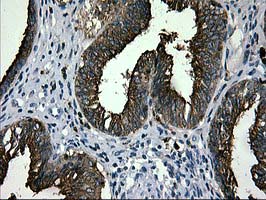MAC-2-BP / LGALS3BP Antibody - IHC of paraffin-embedded Adenocarcinoma of Human endometrium tissue using anti-LGALS3BP mouse monoclonal antibody.
