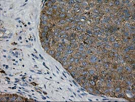MAC-2-BP / LGALS3BP Antibody - IHC of paraffin-embedded Carcinoma of Human bladder tissue using anti-LGALS3BP mouse monoclonal antibody.