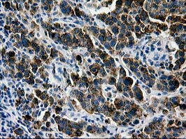 MAC-2-BP / LGALS3BP Antibody - IHC of paraffin-embedded Carcinoma of Human lung tissue using anti-LGALS3BP mouse monoclonal antibody.