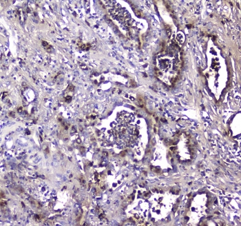 MAC-2-BP / LGALS3BP Antibody - IHC testing of FFPE human intestinal cancer tissue with LGALS3BP antibody at 1ug/ml. Required HIER: steam section in pH6 citrate buffer for 20 min and allow to cool prior to staining.