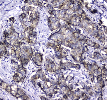 MAC-2-BP / LGALS3BP Antibody - IHC testing of FFPE human breast cancer tissue with LGALS3BP antibody at 1ug/ml. Required HIER: steam section in pH6 citrate buffer for 20 min and allow to cool prior to staining.