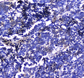 MAC-2-BP / LGALS3BP Antibody - IHC testing of FFPE human lung cancer tissue with LGALS3BP antibody at 1ug/ml. Required HIER: steam section in pH6 citrate buffer for 20 min and allow to cool prior to staining.