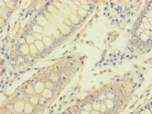 MACROD1 / LRP16 Antibody - Immunohistochemistry of paraffin-embedded human colon cancer using MACROD1 Antibody at dilution of 1:100