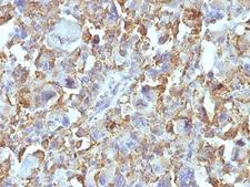 Macrophage + Histiocytoma Marker Antibody - Formalin-fixed, paraffin-embedded human Histiocytoma stained with Macrophage antibody (D11).  This image was taken for the unmodified form of this product. Other forms have not been tested.
