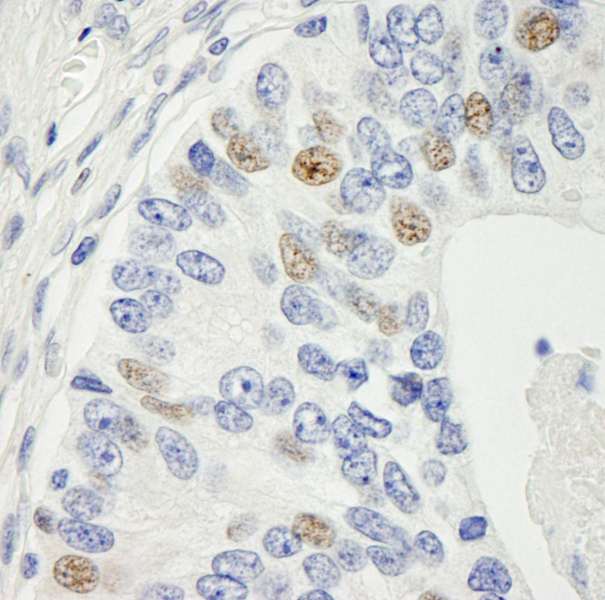 MAD1L1 / MAD1 Antibody - Detection of Human MAD1 by Immunohistochemistry. Sample: FFPE section of human prostate adenocarcinoma. Antibody: Affinity purified rabbit anti-MAD1 used at a dilution of 1:250.