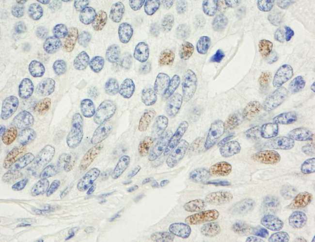 MAD1L1 / MAD1 Antibody - Detection of Human MAD1 by Immunohistochemistry. Sample: FFPE section of human prostate carcinoma. Antibody: Affinity purified rabbit anti-MAD1 used at a dilution of 1:1000 (1 Detection: DAB.