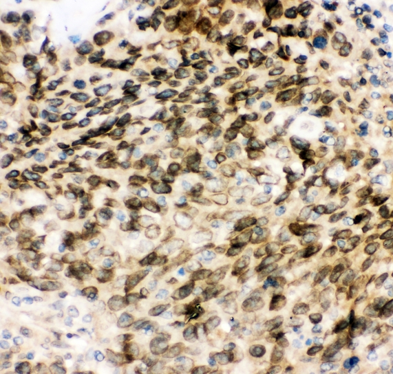 MAD1L1 / MAD1 Antibody - IHC analysis of MAD1 using anti-MAD1 antibody. MAD1 was detected in paraffin-embedded section of human intestinal cancer tissues. Heat mediated antigen retrieval was performed in citrate buffer (pH6, epitope retrieval solution) for 20 mins. The tissue section was blocked with 10% goat serum. The tissue section was then incubated with 1µg/ml rabbit anti-MAD1 Antibody overnight at 4°C. Biotinylated goat anti-rabbit IgG was used as secondary antibody and incubated for 30 minutes at 37°C. The tissue section was developed using Strepavidin-Biotin-Complex (SABC) with DAB as the chromogen.