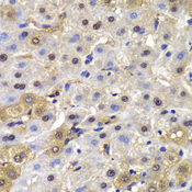 MAD1L1 / MAD1 Antibody - Immunohistochemistry of paraffin-embedded human liver cancer using MAD1L1 antibodyat dilution of 1:100 (40x lens).