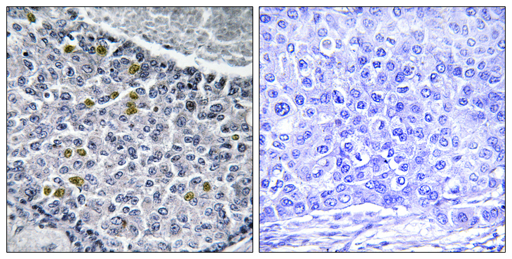 MAD1L1 / MAD1 Antibody - Immunohistochemistry analysis of paraffin-embedded human breast carcinoma, using MAD1 (Phospho-Ser428) Antibody. The picture on the right is blocked with the phospho peptide.