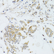 MAD2B / REV7 Antibody - Immunohistochemistry of paraffin-embedded human gastric cancer tissue.