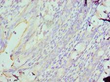 MAD2L1 / MAD2 Antibody - Immunohistochemistry of paraffin-embedded human rectal cancer using antibody 1:100 dilution.