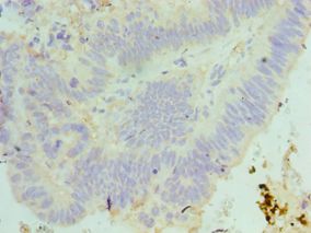 MAD2L1 / MAD2 Antibody - Immunohistochemistry of paraffin-embedded human colon cancer using antibody at 1:100 dilution.