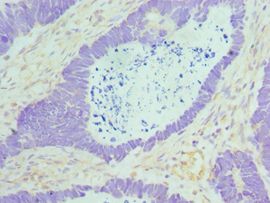MAD2L1 / MAD2 Antibody - Immunohistochemistry of paraffin-embedded human ovarian cancer using antibody 1:100 dilution.