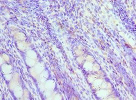 MAD2L1 / MAD2 Antibody - Immunohistochemistry of paraffin-embedded human rectal cancer using antibody at 1:100 dilution.