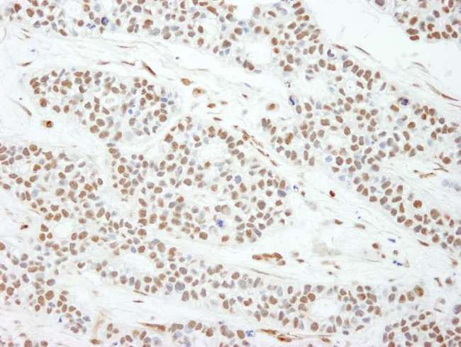 MAD2L1 / MAD2 Antibody - Detection of Human MAD2 by Immunohistochemistry. Sample: FFPE section of human breast carcinoma Antibody: Affinity purified rabbit anti-MAD2 used at a dilution of 1:250.