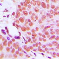 MAEA / EMP Antibody - Immunohistochemical analysis of EMP staining in human breast cancer formalin fixed paraffin embedded tissue section. The section was pre-treated using heat mediated antigen retrieval with sodium citrate buffer (pH 6.0). The section was then incubated with the antibody at room temperature and detected using an HRP conjugated compact polymer system. DAB was used as the chromogen. The section was then counterstained with hematoxylin and mounted with DPX.