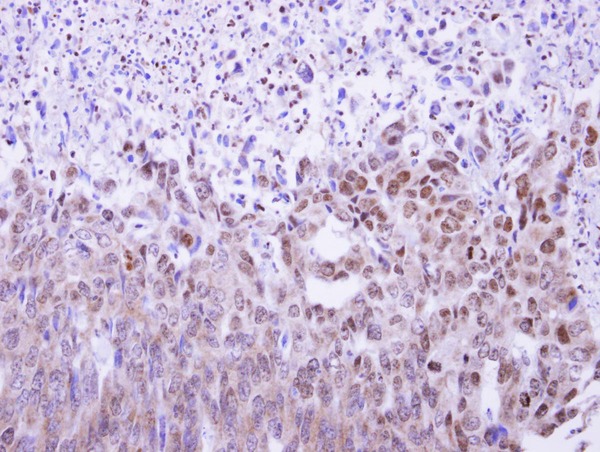 MAF1 Antibody - MAF1 antibody detects MAF1 protein at nucleus and cytoplasm on colon carcinoma by immunohistochemical analysis. Sample: Paraffin-embedded colon carcinoma. MAF1 antibody dilution:1:500.