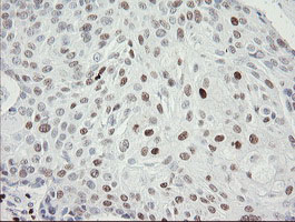 MAFB Antibody - IHC of paraffin-embedded Carcinoma of Human lung tissue using anti-MAFB mouse monoclonal antibody. (Heat-induced epitope retrieval by 10mM citric buffer, pH6.0, 100C for 10min).