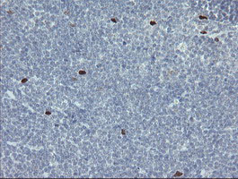 MAFB Antibody - IHC of paraffin-embedded Human lymphoma tissue using anti-MAFB mouse monoclonal antibody. (Heat-induced epitope retrieval by 10mM citric buffer, pH6.0, 100C for 10min).