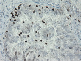 MAFB Antibody - IHC of paraffin-embedded Adenocarcinoma of Human ovary tissue using anti-MAFB mouse monoclonal antibody. (Heat-induced epitope retrieval by 10mM citric buffer, pH6.0, 100C for 10min).