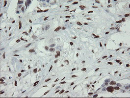 MAFB Antibody - IHC of paraffin-embedded Adenocarcinoma of Human breast tissue using anti-MAFB mouse monoclonal antibody.