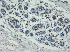 MAFB Antibody - IHC of paraffin-embedded Carcinoma of Human lung tissue using anti-MAFB mouse monoclonal antibody.
