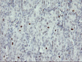 MAFB Antibody - IHC of paraffin-embedded Carcinoma of Human thyroid tissue using anti-MAFB mouse monoclonal antibody.