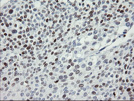 MAFB Antibody - IHC of paraffin-embedded Carcinoma of Human bladder tissue using anti-MAFB mouse monoclonal antibody.