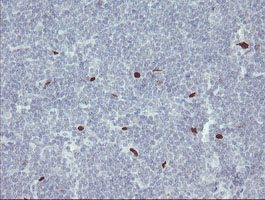 MAFB Antibody - IHC of paraffin-embedded Human lymphoma tissue using anti-MAFB mouse monoclonal antibody.