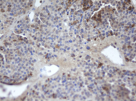 MAFB Antibody - IHC of paraffin-embedded Carcinoma of Human pancreas tissue using anti-MAFB mouse monoclonal antibody.
