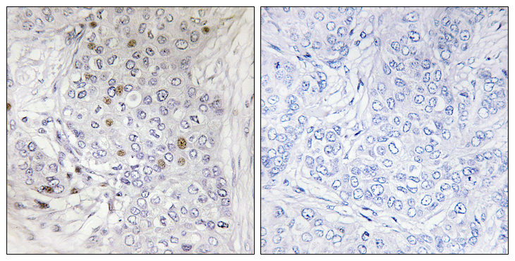 MAFF Antibody - Immunohistochemistry analysis of paraffin-embedded human breast carcinoma tissue, using MAFF Antibody. The picture on the right is blocked with the synthesized peptide.