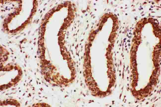 MAG Antibody - Anti-MAG antibody, IHC(P): Human Mammary Cancer Tissue