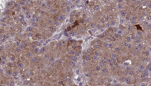 MAG Antibody - 1:100 staining human liver carcinoma tissues by IHC-P. The sample was formaldehyde fixed and a heat mediated antigen retrieval step in citrate buffer was performed. The sample was then blocked and incubated with the antibody for 1.5 hours at 22°C. An HRP conjugated goat anti-rabbit antibody was used as the secondary.