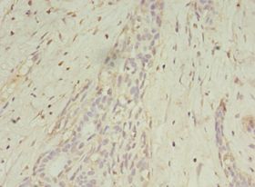 MAGE10 / MAGEA10 Antibody - Immunohistochemistry of paraffin-embedded human breast cancer using antibody at 1:100 dilution.  This image was taken for the unconjugated form of this product. Other forms have not been tested.