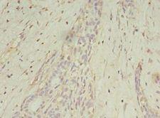 MAGE10 / MAGEA10 Antibody - Immunohistochemistry of paraffin-embedded human breast cancer using antibody at 1:100 dilution.  This image was taken for the unconjugated form of this product. Other forms have not been tested.