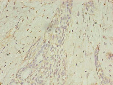 MAGE10 / MAGEA10 Antibody - Immunohistochemistry of paraffin-embedded human breast cancer using MAGEA10 Antibody at dilution of 1:100
