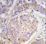 MAGE10 / MAGEA10 Antibody - Formalin-fixed and paraffin-embedded human breast carcinoma tissue reacted with MAGEA10 antibody , which was peroxidase-conjugated to the secondary antibody, followed by DAB staining. This data demonstrates the use of this antibody for immunohistochemistry; clinical relevance has not been evaluated.