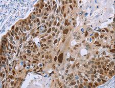 MAGE10 / MAGEA10 Antibody - Immunohistochemistry of paraffin-embedded Human esophagus cancer using MAGEA10 Polyclonal Antibody at dilution of 1:50.