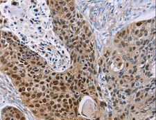 MAGE10 / MAGEA10 Antibody - Immunohistochemistry of paraffin-embedded Human esophagus cancer using MAGEA10 Polyclonal Antibody at dilution of 1:30.