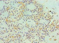 MAGEA1 / MAGE 1 Antibody - Immunohistochemistry of paraffin-embedded human breast cancer using antibody at 1:100 dilution.