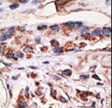 MAGEA1 / MAGE 1 Antibody - Formalin-fixed and paraffin-embedded human cancer tissue reacted with the primary antibody, which was peroxidase-conjugated to the secondary antibody, followed by DAB staining. This data demonstrates the use of this antibody for immunohistochemistry; clinical relevance has not been evaluated. BC = breast carcinoma; HC = hepatocarcinoma.