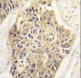 MAGEA1 / MAGE 1 Antibody - Formalin-fixed and paraffin-embedded human lung carcinoma tissue reacted with MAGEA1 Antibody , which was peroxidase-conjugated to the secondary antibody, followed by DAB staining. This data demonstrates the use of this antibody for immunohistochemistry; clinical relevance has not been evaluated.