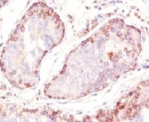 MAGEA1 / MAGE 1 Antibody - Formalin-fixed, paraffin-embedded human testicular carcinoma stained with MAGE-1 antibody (MZ2E/838).  This image was taken for the unmodified form of this product. Other forms have not been tested.