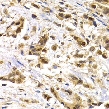 MAGEA1 / MAGE 1 Antibody - Immunohistochemistry of paraffin-embedded human breast cancer tissue.